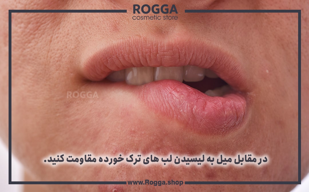 در مقابل میل به لیسیدن لب های ترک خورده مقاومت کنید