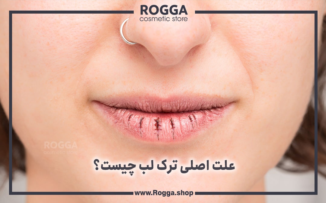 علت اصلی ترک لب چیست؟