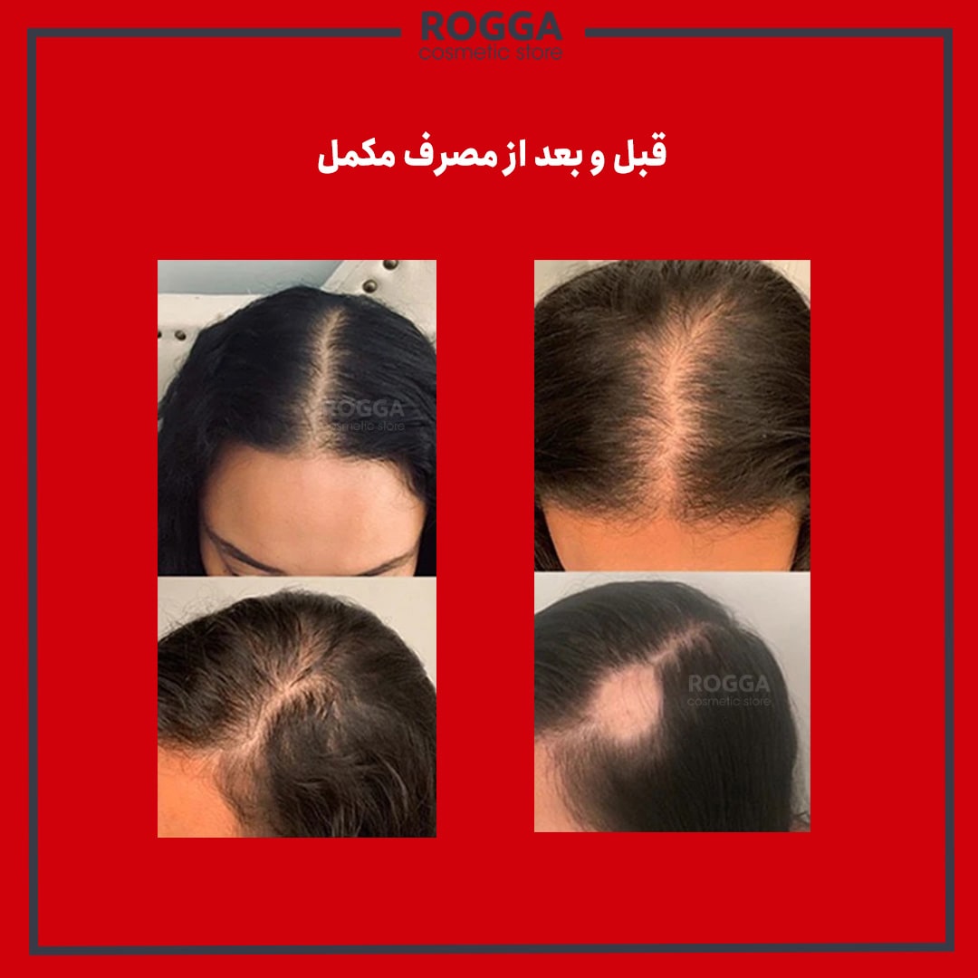 قبل و بعد از مصرف هیرتامین