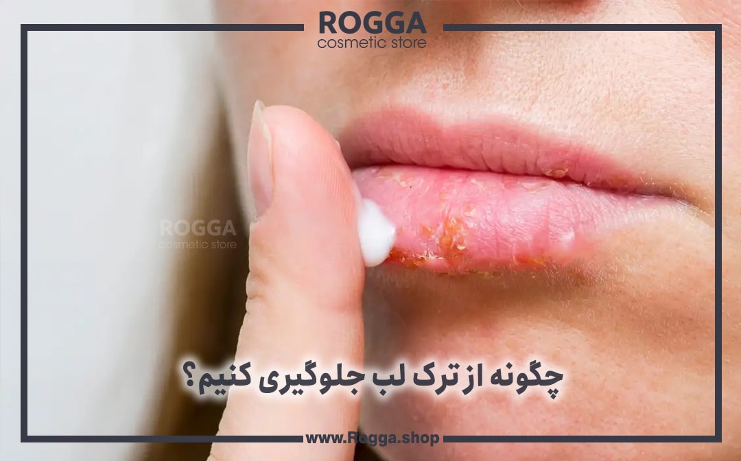 چگونه از ترک لب جلوگیری کنیم؟