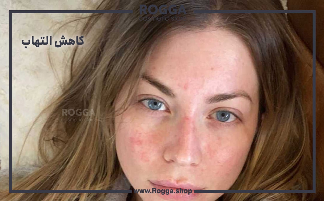 کاهش التهاب