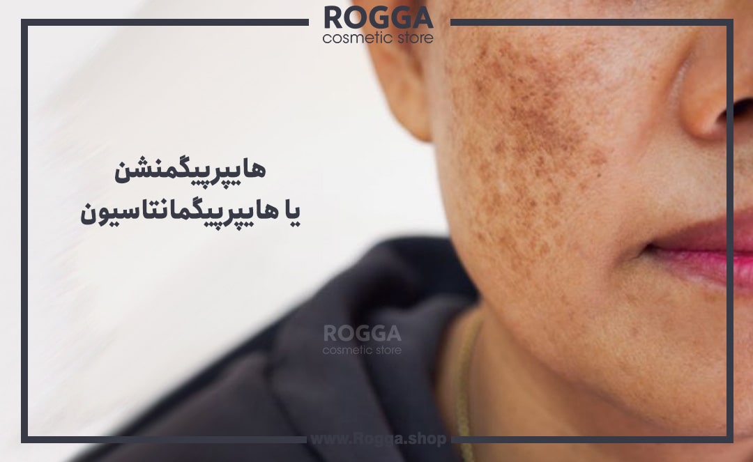 هایپرپیگمنشن
