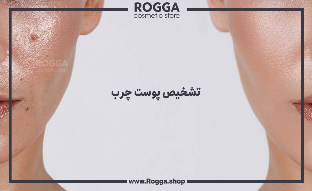 تشخیص-پوست-چرب