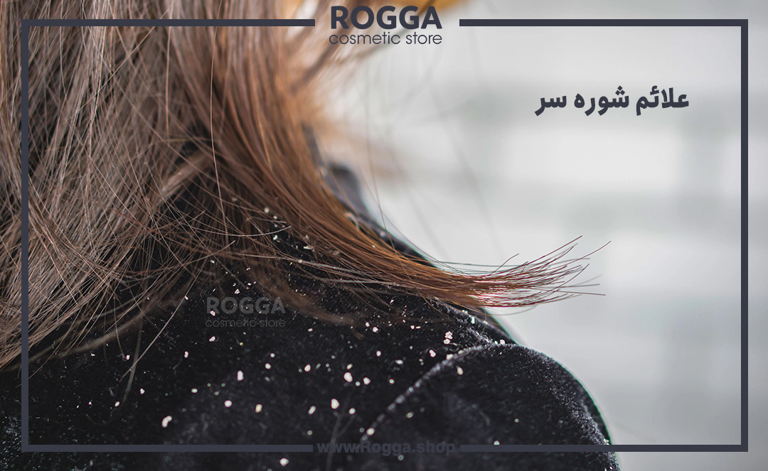 علائم-شوره-سر