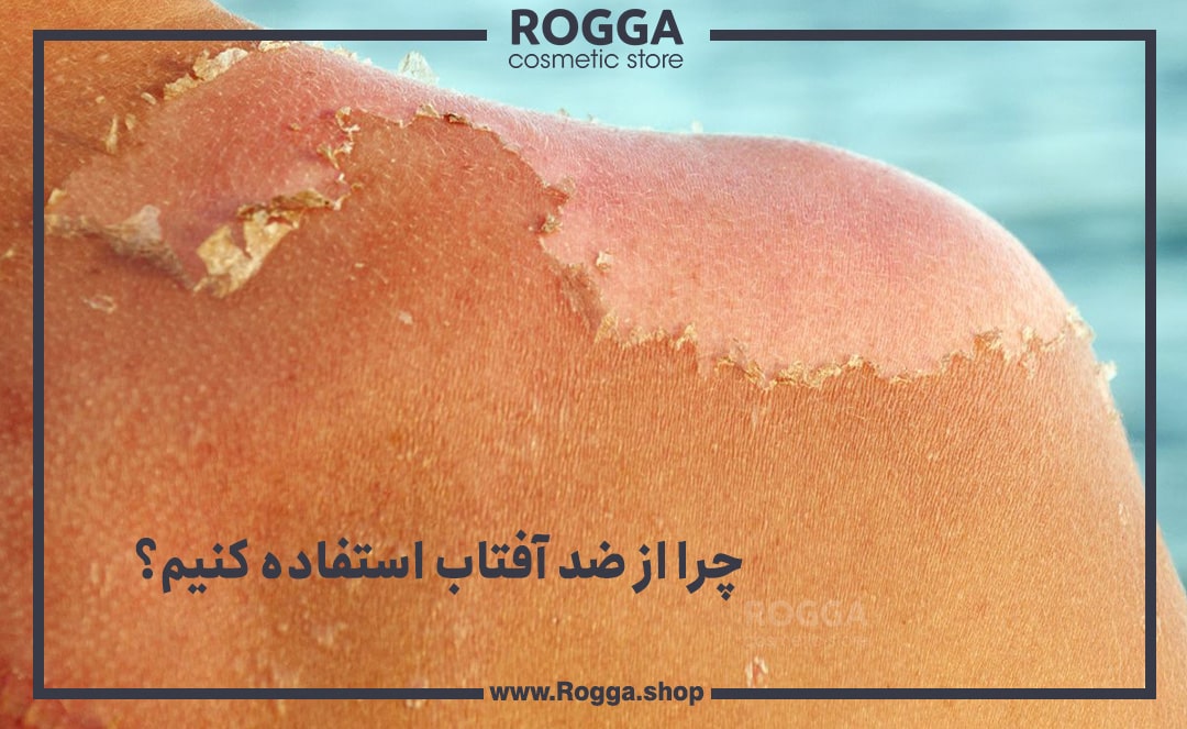 چرا-از-ضد-آفتاب-استفاده-کنیم؟