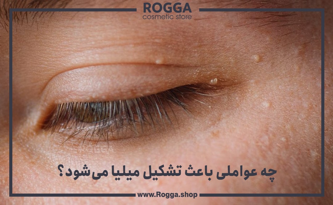 چه-عواملی-باعث-تشکیل-میلیا-می_شود؟