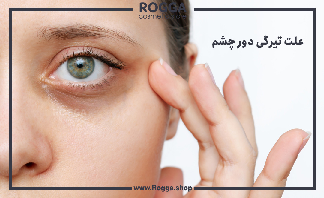 علت-تیرگی-دور-چشم