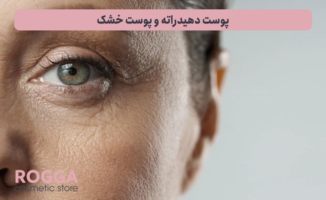 پوست-دهیدراته-و-پوست-خشک-min