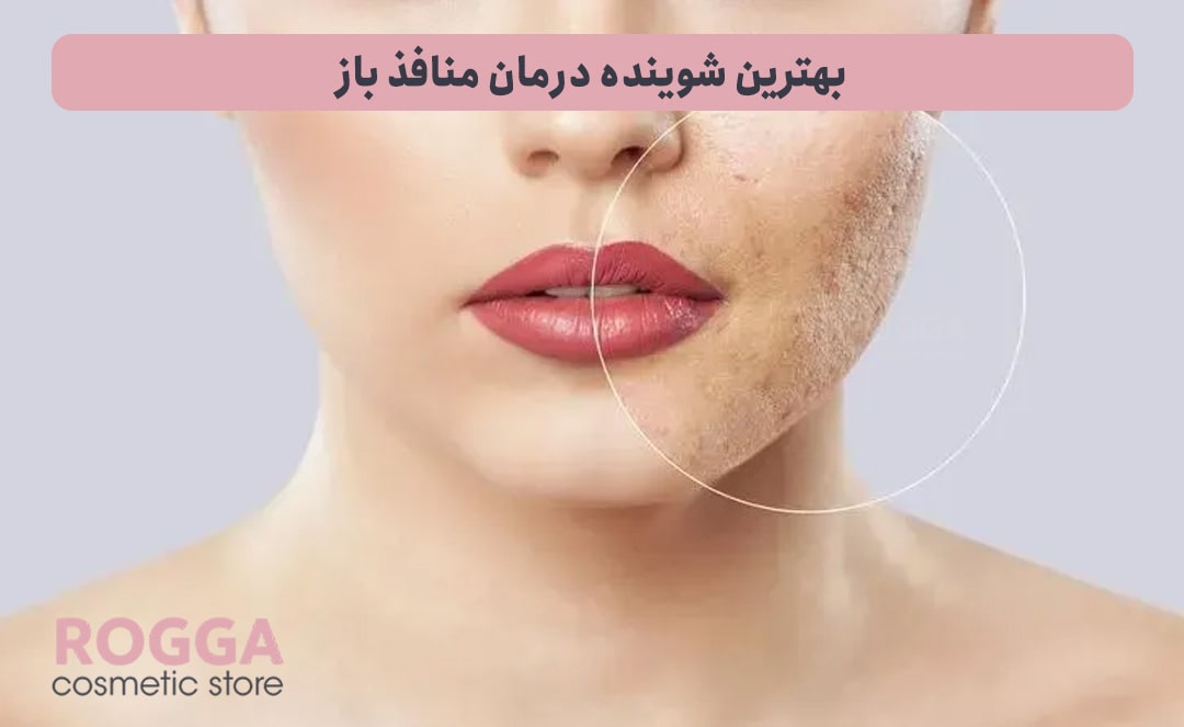 بهترین-شوینده-درمان-منافذ-باز
